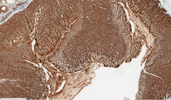 5x magnification of CLDN18-stained normal gastric epithelium and tumour cells.