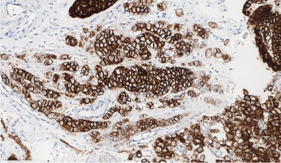stain-gastriccancer-20x